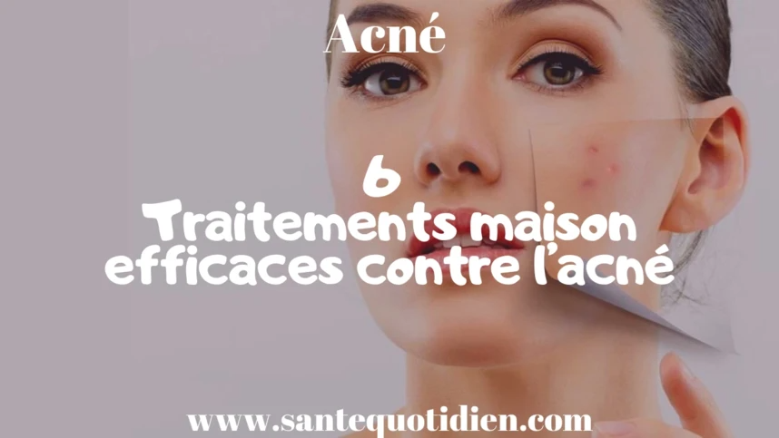 6 traitements maison efficaces contre l’acné