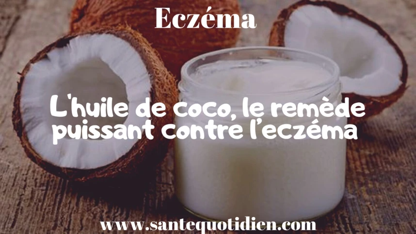 L'huile de coco, le remède puissant contre l’eczéma