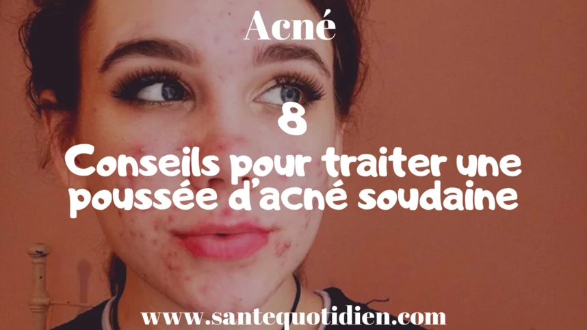 8 conseils pour traiter une poussée d’acné soudaine