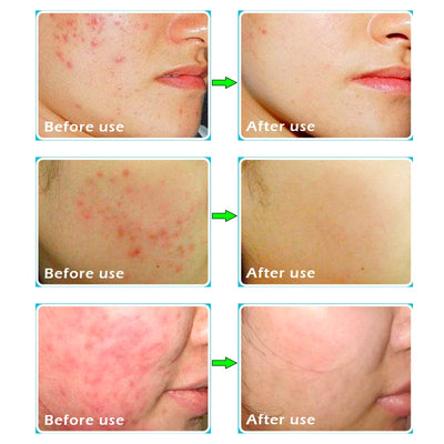 Crème anti acné adulte efficace