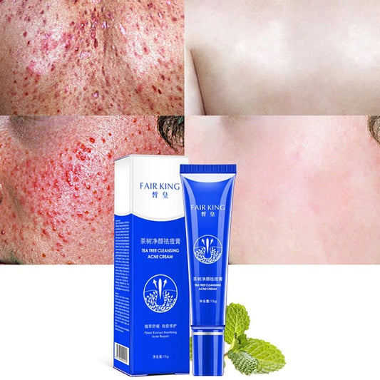 Crème miracle pour l'acné sévère - Traitement efficace pour une peau claire et radieuse