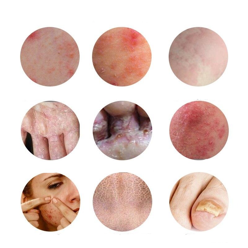 Creme eczema sans ordonnance