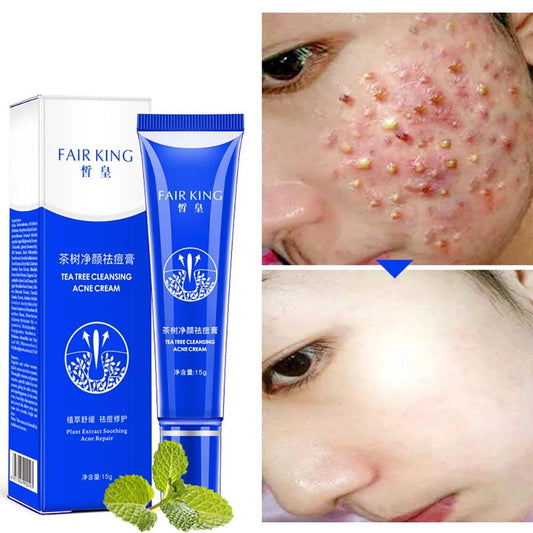 Crème miracle pour l'acné sévère - Traitement efficace pour une peau claire et radieuse